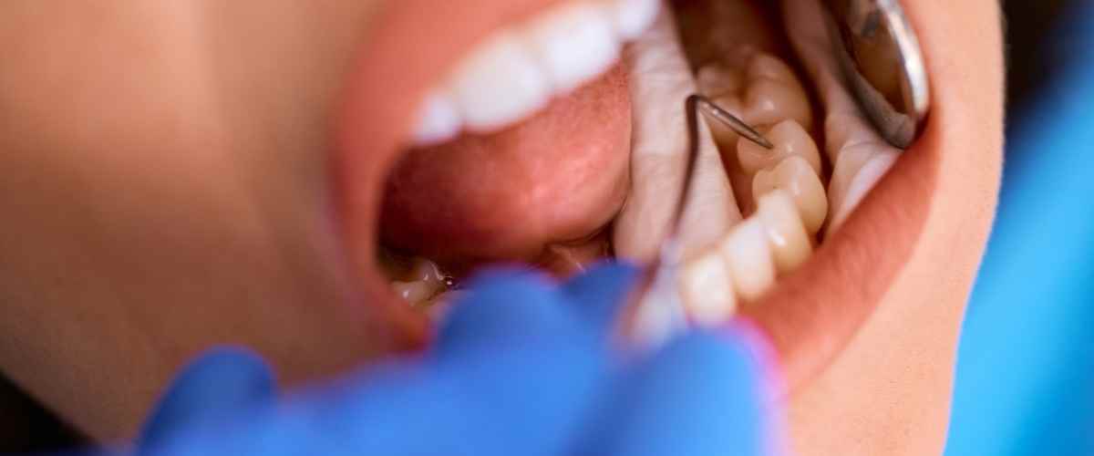 Why Are “Calcium Deposits” on Your Teeth Bad for Your Smile?